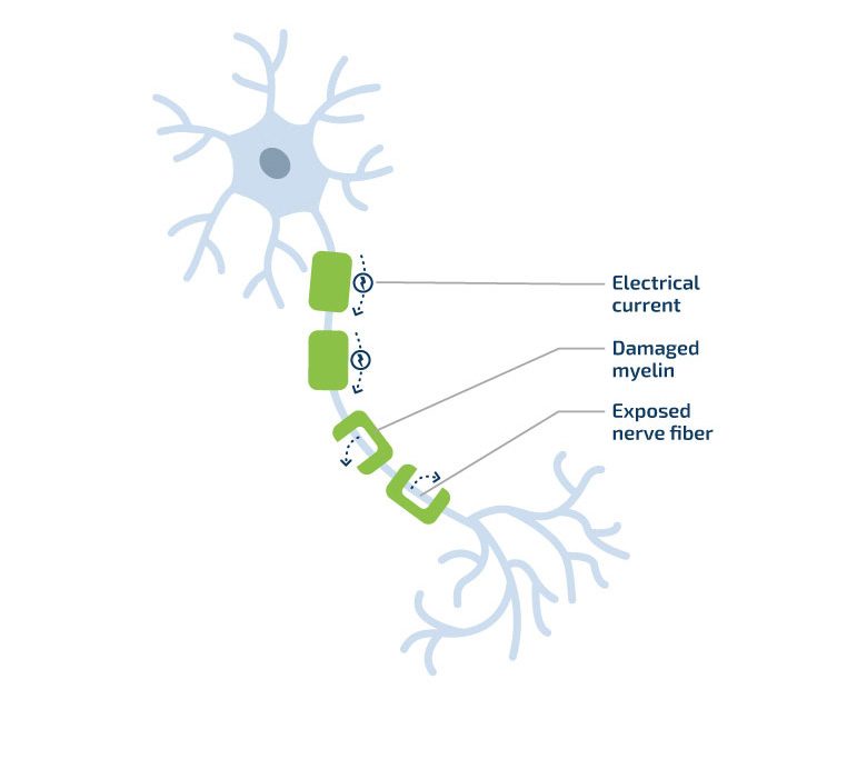 Explanation of why MG happens