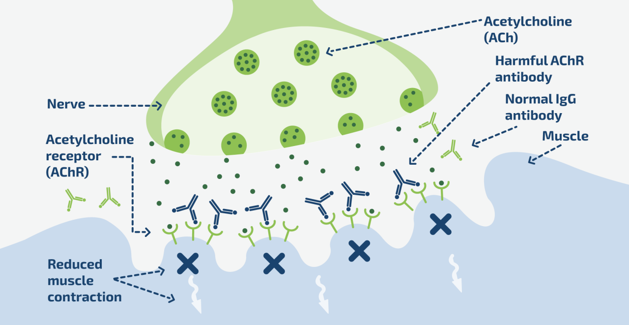 Explanation of why MG happens